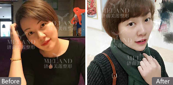 济南美莲医院割双眼皮多少钱
