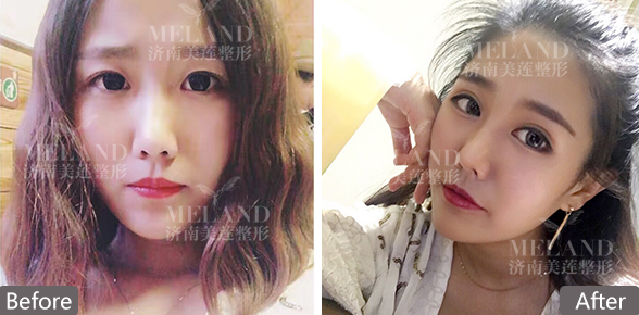 济南美莲韩旭双眼皮多少钱