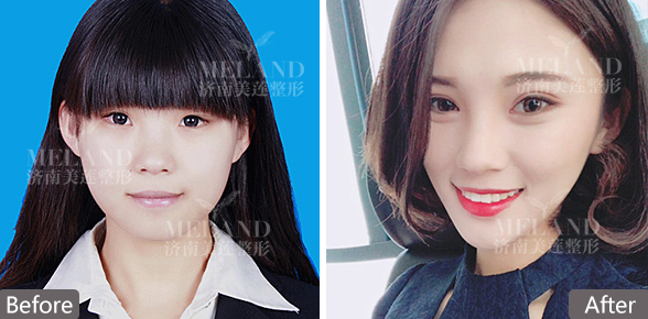 山东济南双眼皮手术价格表