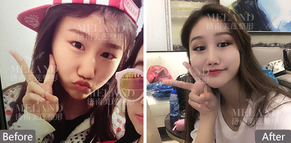 济南美莲割双眼皮价格