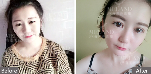 济南哺乳期能做双眼皮吗