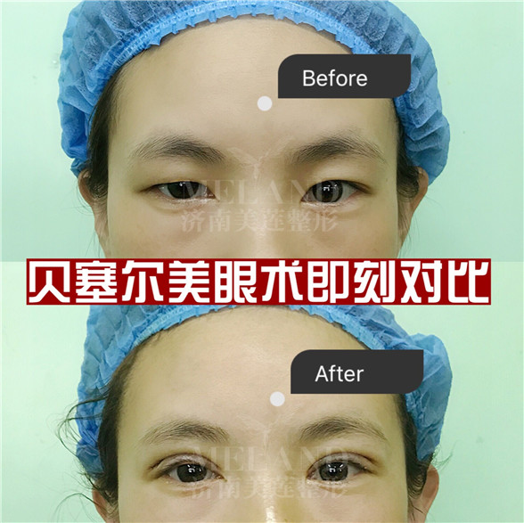 济南美莲美容整形割双眼皮自然的宽度是多