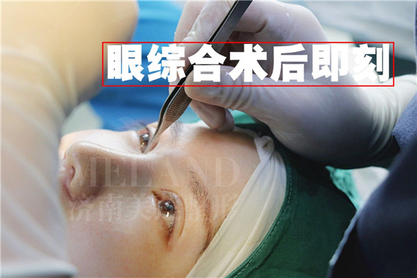 济南美莲美容整形割双眼皮会有疤痕吗