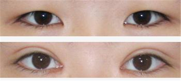 济南双眼皮手术价格表