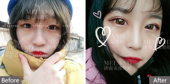 济南什么季节割双眼皮好