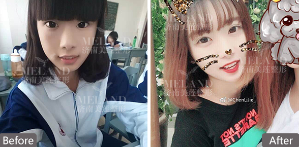 济南哪里做全切双眼皮好