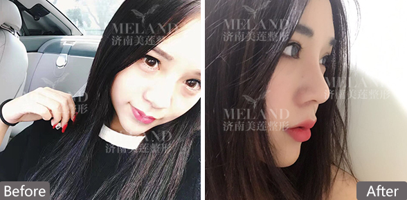 济南美莲双眼皮怎么样