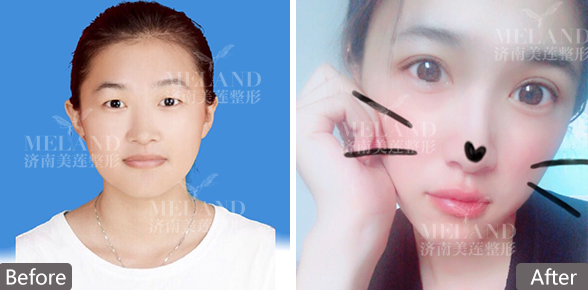 济南美莲做的双眼皮图片