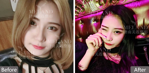 济南双眼皮多少钱