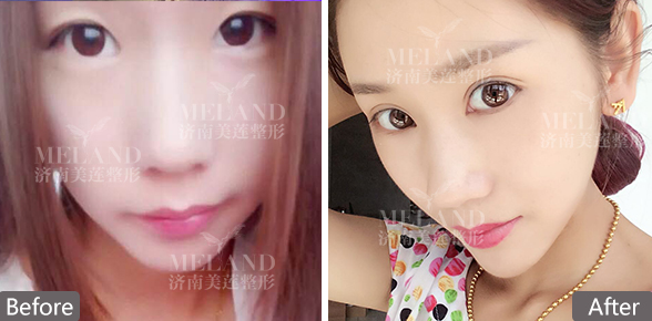 济南哪割双眼皮好