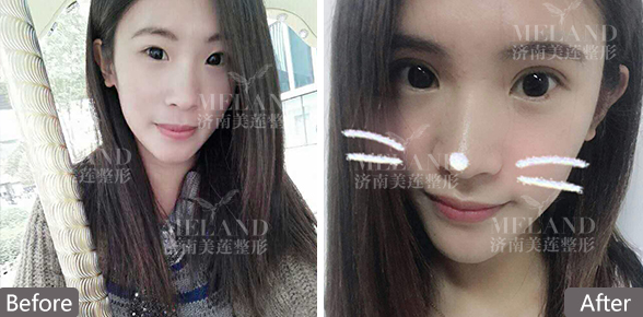 济南美莲整形埋线双眼皮手术恢复过程