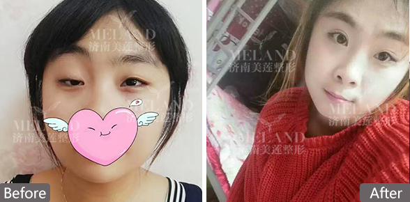 济南哪里割的双眼皮好啊