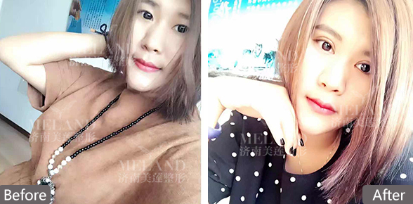 济南美莲整形割双眼皮多少钱啊