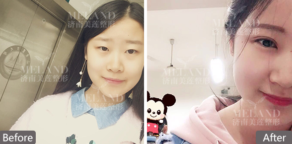 济南美莲整容医院怎么样