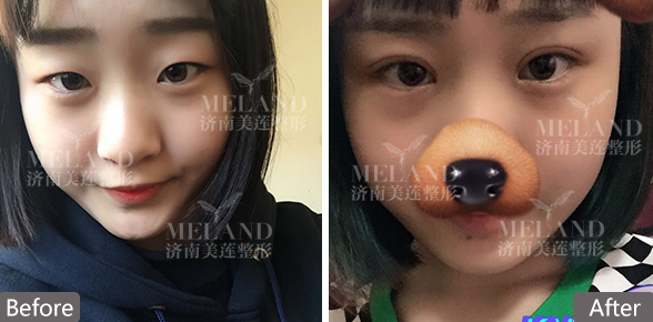 济南哪家医院做双眼皮好