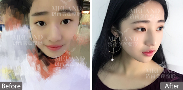 济南美莲整形割双眼皮效果怎么样