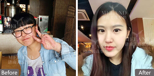 济南美莲整形做双眼皮多少钱