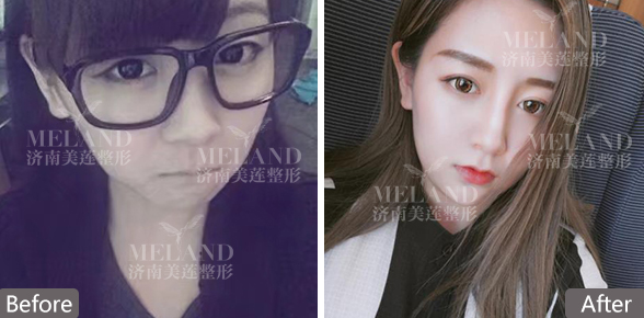 济南微创双眼皮手术怎么做的