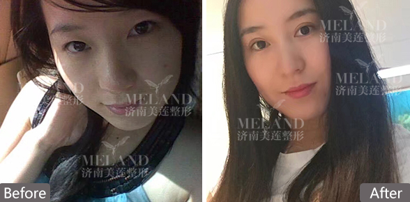 济南微创双眼皮有哪些优点