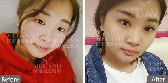 济南美莲美容整形割双眼皮会不会疼