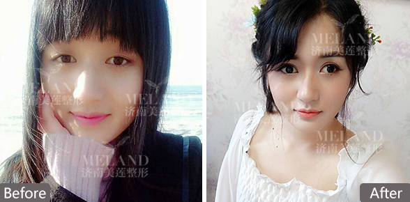 济南双眼皮修复手术要注意哪些