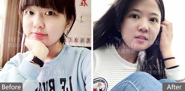 济南开外眼角整形风险大吗