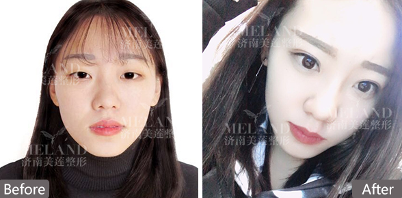 济南美莲美容整形全切双眼皮效果怎么样