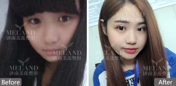 济南美莲美容整形埋线双眼皮自然吗