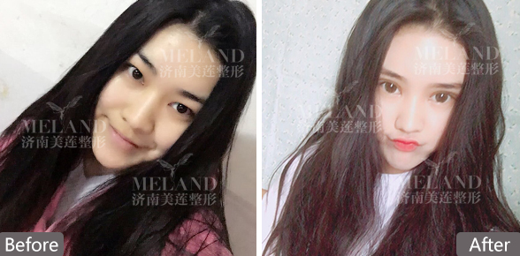 济南双眼皮手术有哪些方法