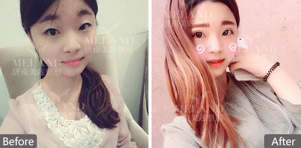 济南做双眼皮多少钱