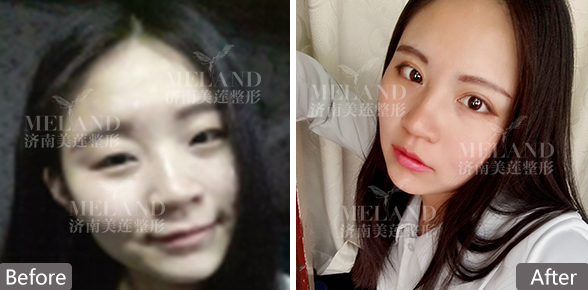 济南美莲美容整形割双眼皮效果怎么样 自然