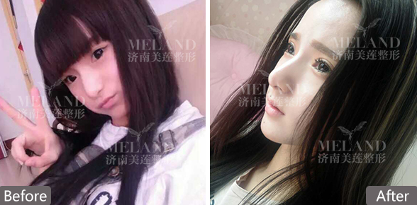 济南割双眼皮需要多少钱