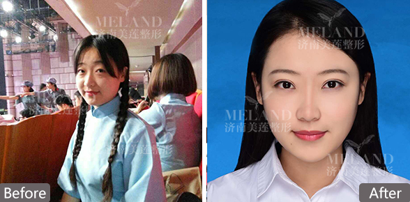 济南修复双眼皮哪家好