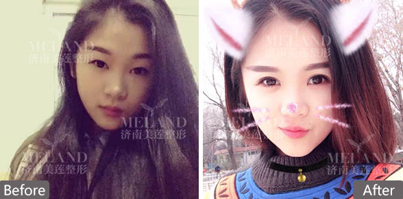 济南美莲美容整形医院割双眼皮价格