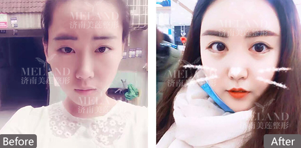 济南美莲整形的整形医院割双眼皮怎么样呢