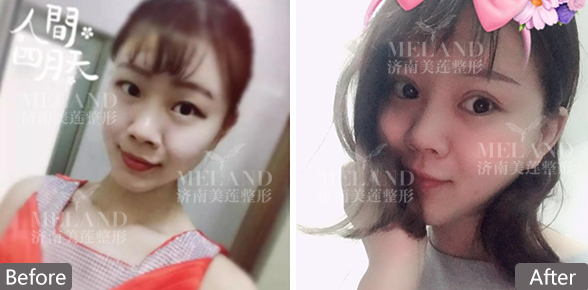 济南美莲整容医院割双眼皮怎么样