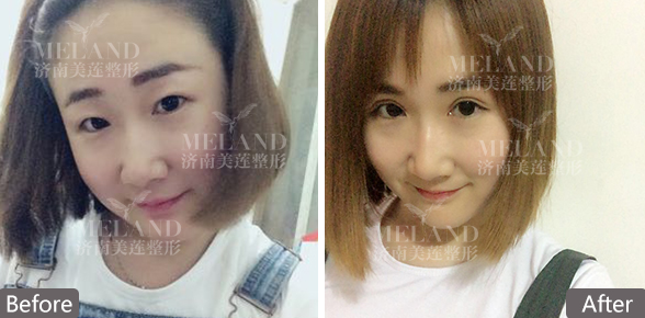 济南美莲医疗美容整形做双眼皮怎么样?