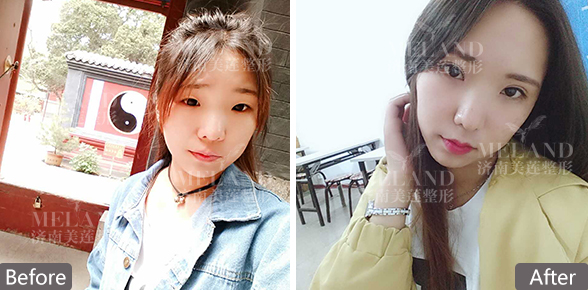 济南哪里割双眼皮好?影响正常生活吗