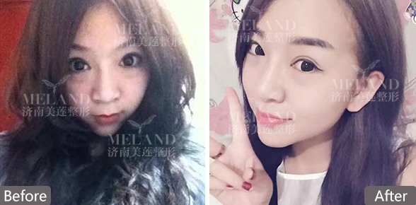 济南美莲美容整形割双眼皮恢复自然需要多长时间