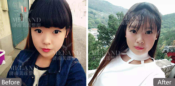 济南美莲美容整形割双眼皮术后如何消肿