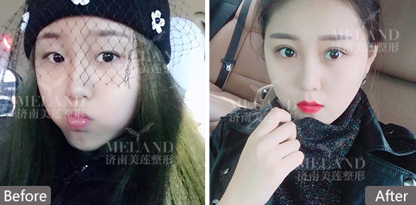 济南美莲美容整形割双眼皮效果如何