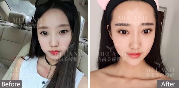 济南美莲美容整形韩旭割双眼皮怎么样