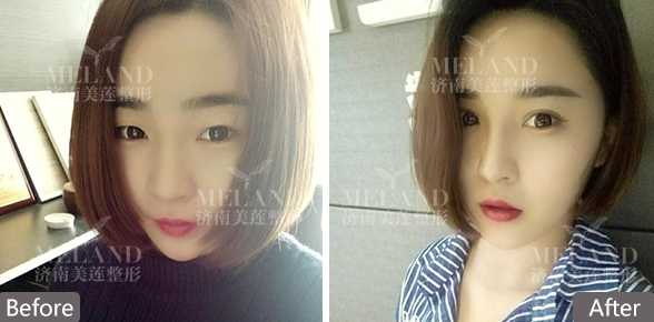 济南美莲美容整形割双眼皮多少钱