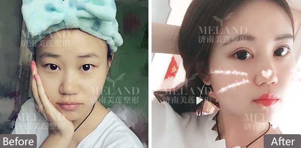 济南美莲美容整形割双眼皮效果怎么样