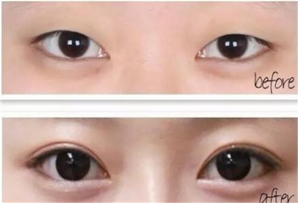 济南美莲双眼皮拆线后如何护理